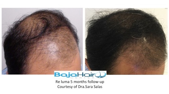 Hair3